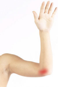 Cubital Tunnel Syndrome Tamarac, FL  Upper Extremity Specialist Coral  Springs, FL